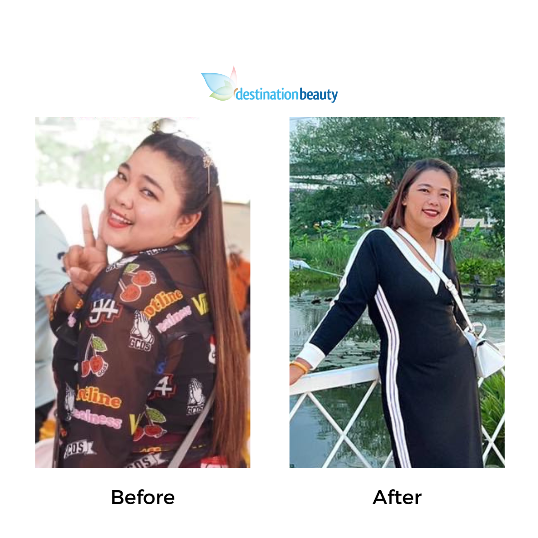 Darika had gastric sleeve