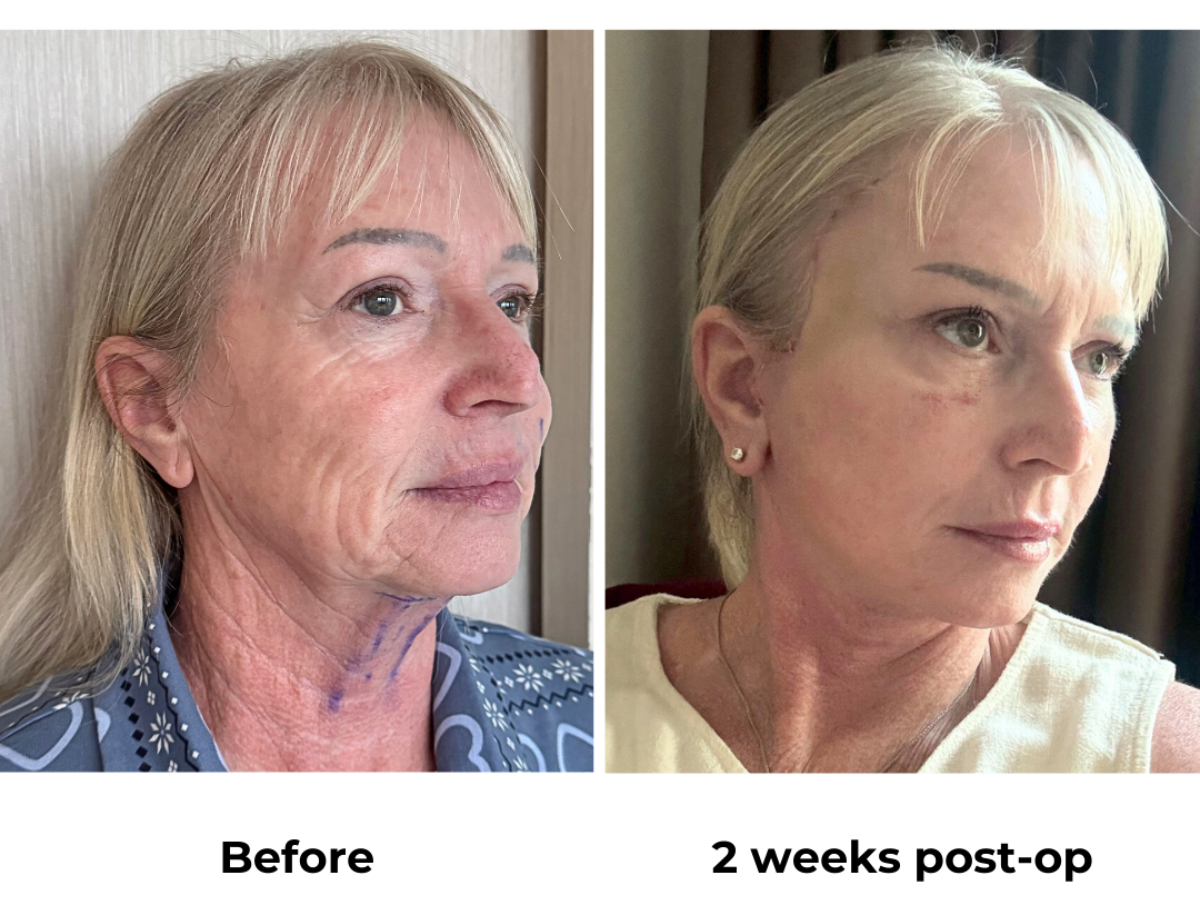 Dawn had FFNL + Fat transfer to face with Dr. NJ (1)