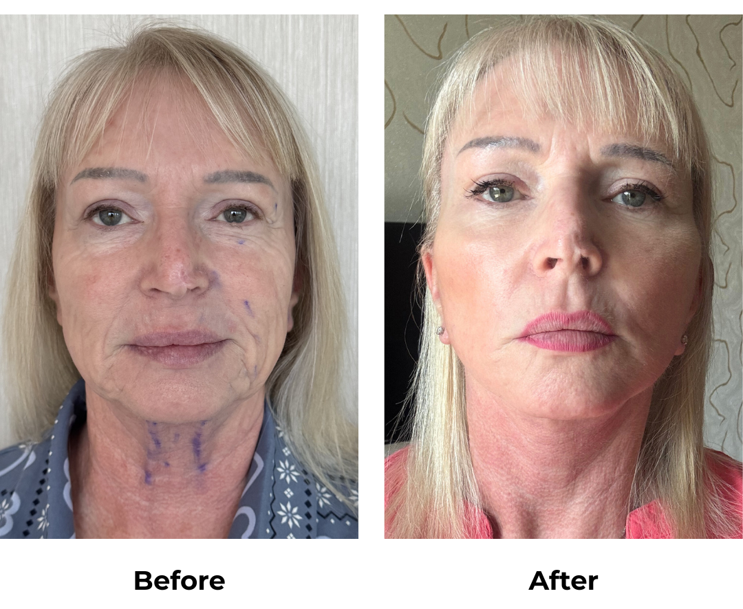 Dawns FFNL + Fat transfer with Dr. NJ (1)