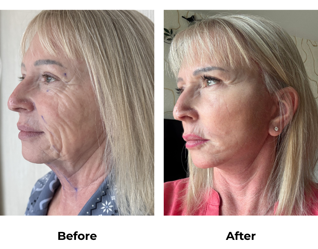 Dawns FFNL + Fat transfer with Dr. NJ (2)