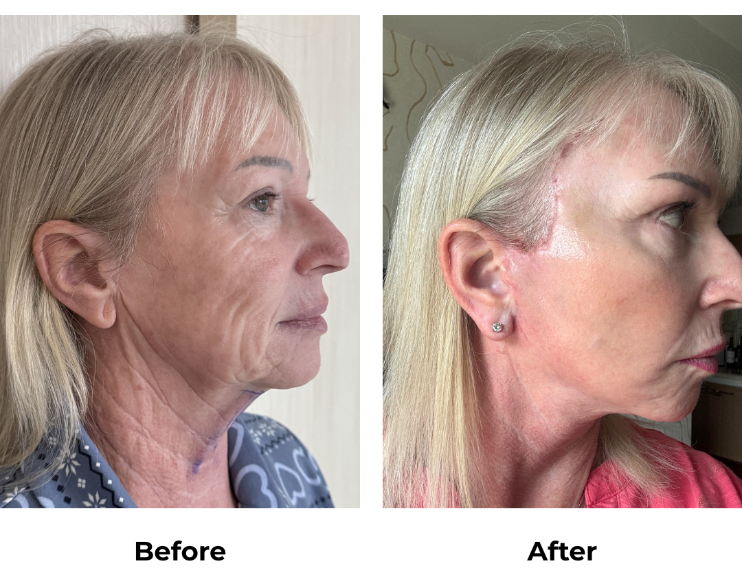 Dawns FFNL + Fat transfer with Dr. NJ