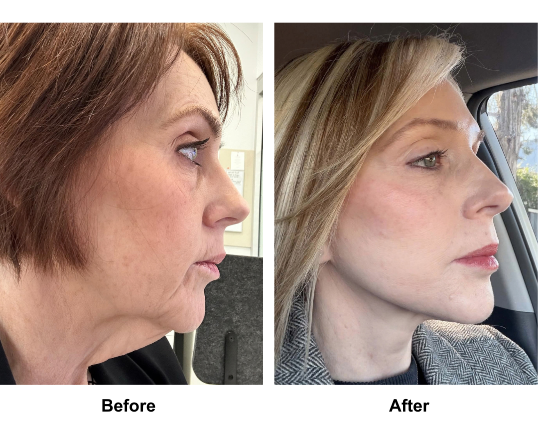 Deannas 1 year facelift update (1)