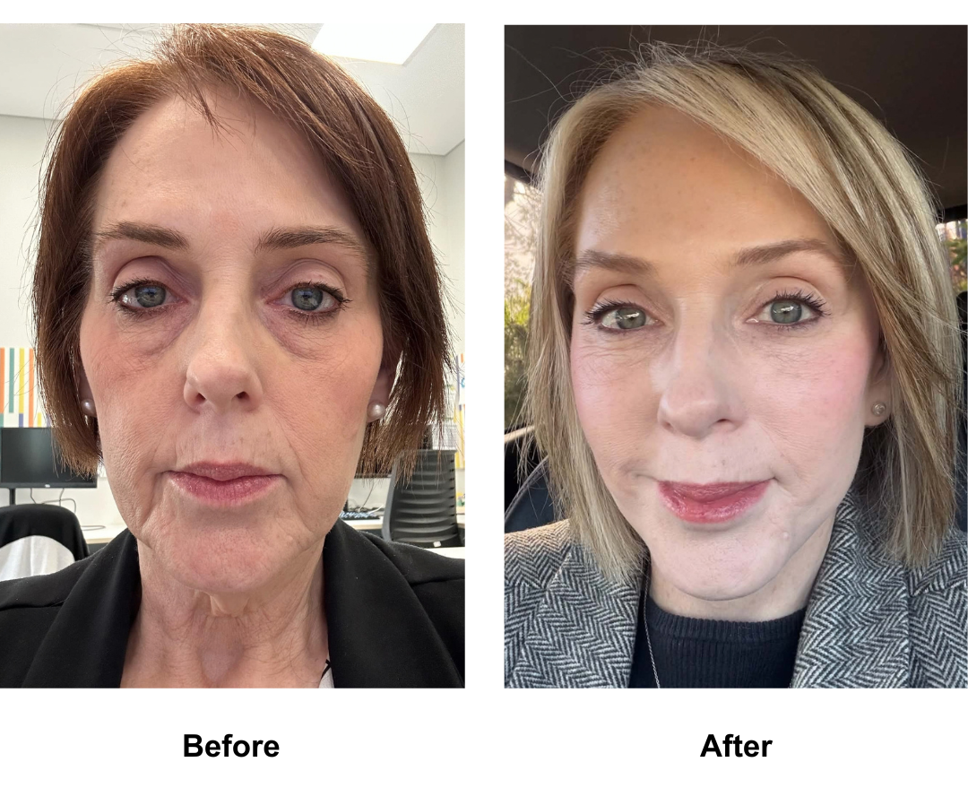 Deannas 1 year facelift update