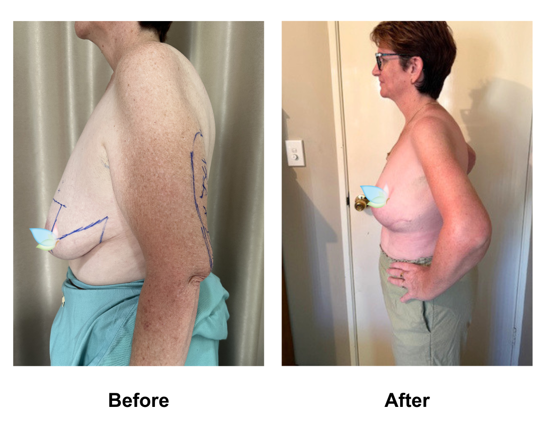 Debbie had BL + AL + Vaser lipo on arms with Dr. Weerachai (1)