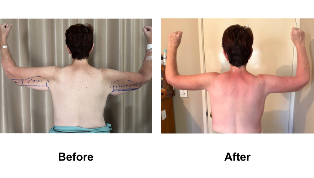 Debbie had BL + AL + Vaser lipo on arms with Dr. Weerachai (2)