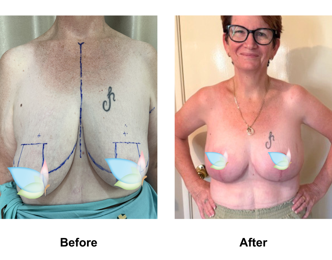Debbie had BL + AL + Vaser lipo on arms with Dr. Weerachai