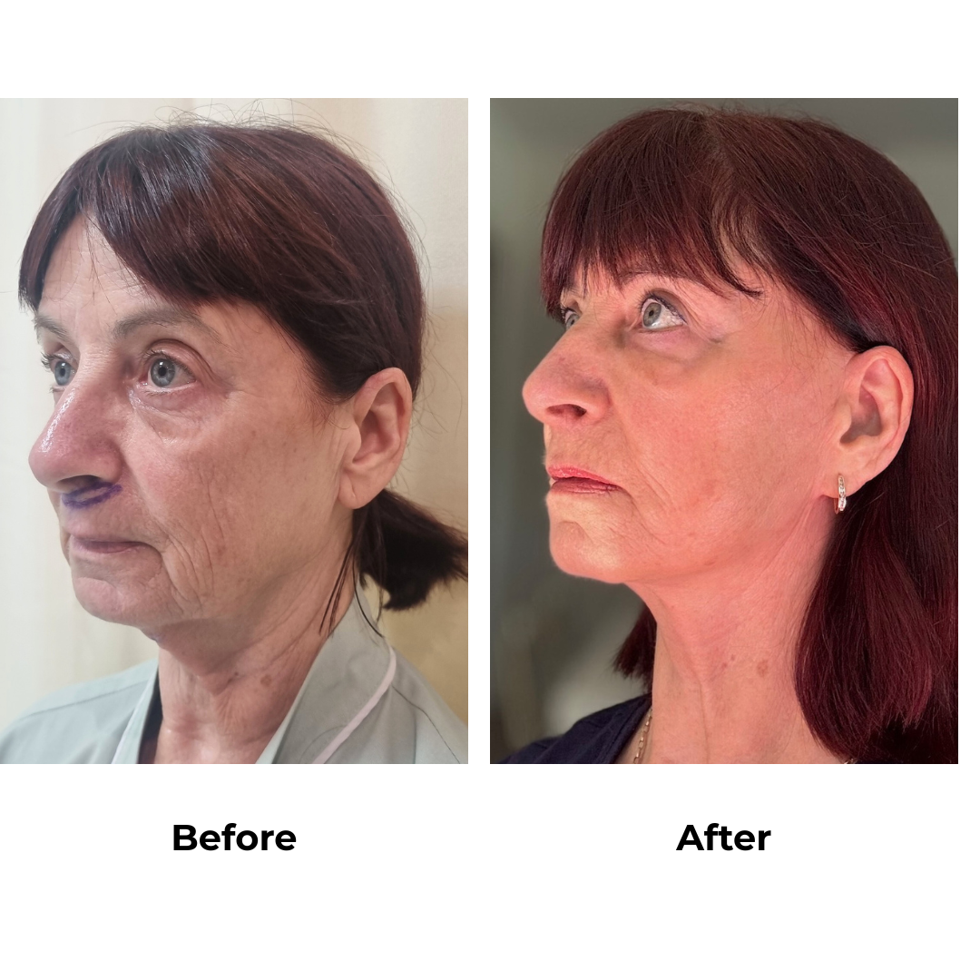 Debbie had FFNL + chin lift + plastymaplasty + fat transfer 2 areas (under eyes, cheek) + upper lip lift with Dr. NJ (2)