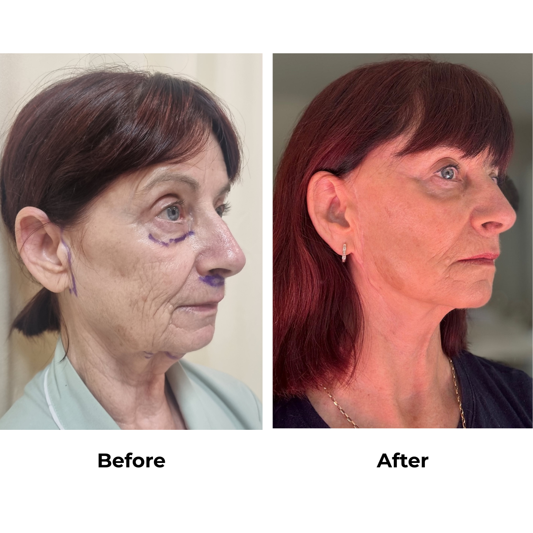 Debbie had FFNL + chin lift + plastymaplasty + fat transfer 2 areas (under eyes, cheek) + upper lip lift with Dr. NJ (3)