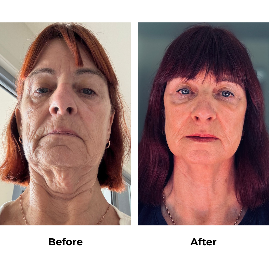 Debbie had FFNL + chin lift + plastymaplasty + fat transfer 2 areas (under eyes, cheek) + upper lip lift with Dr. NJ