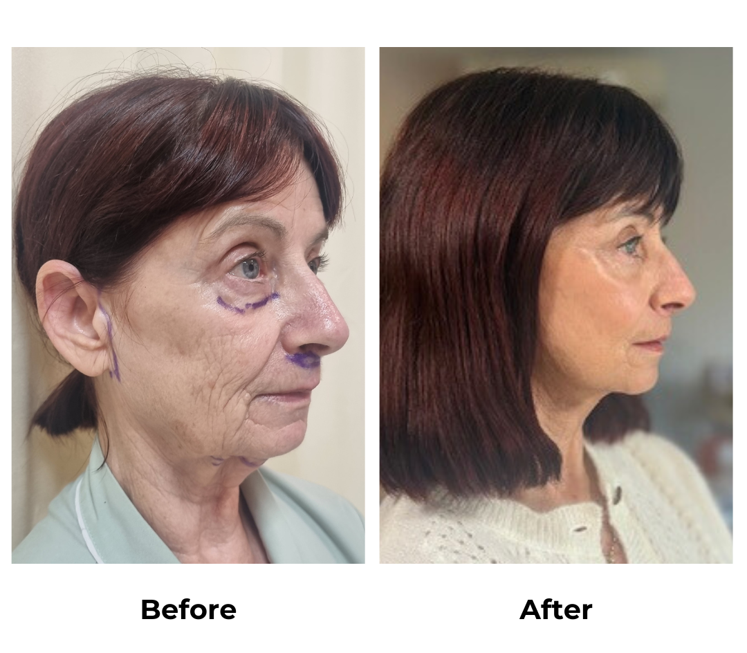 Debbie had facelift with Dr. NJ (2)