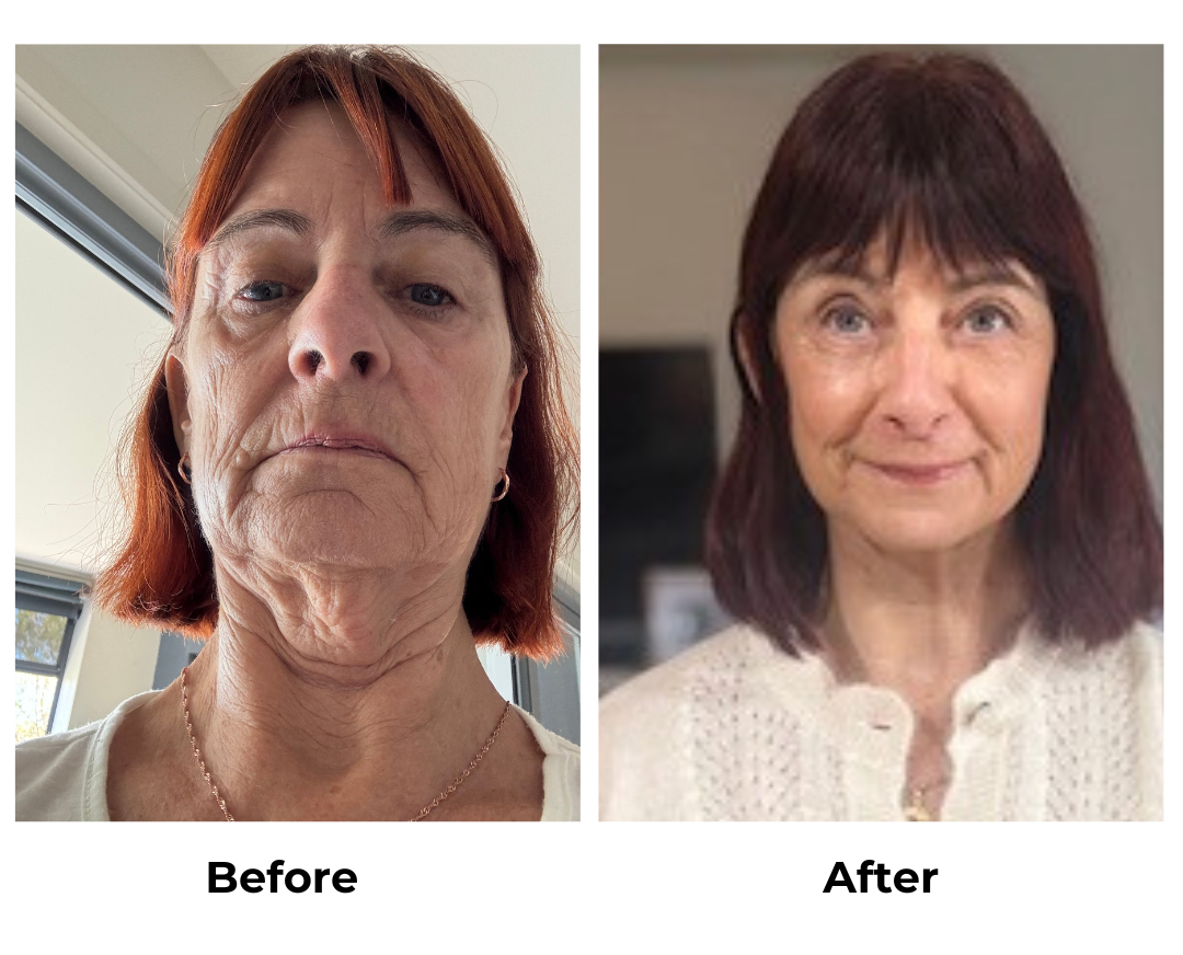 Debbie had facelift with Dr. NJ