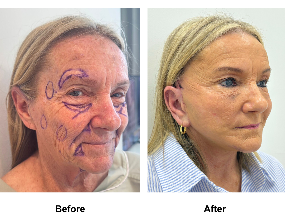 Deborah had FFNL + Fat transfer to face  with Dr. NJ (2)