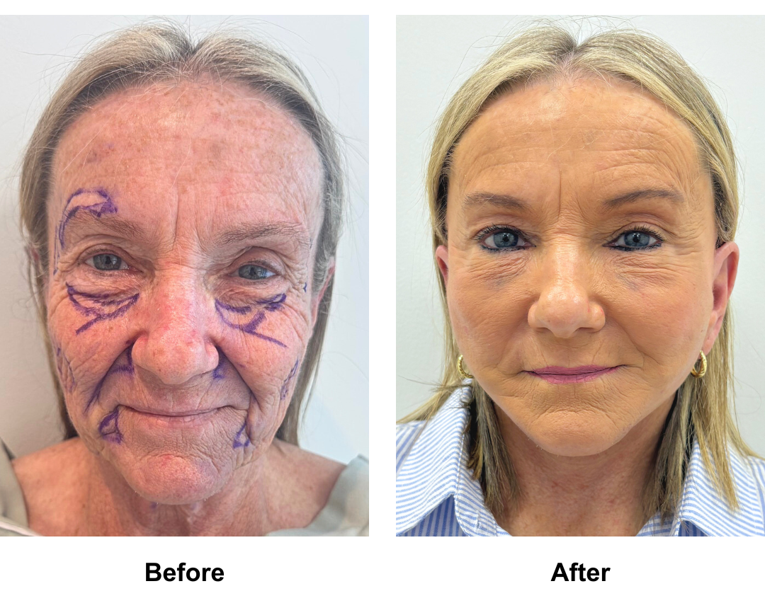 Deborah had FFNL + Fat transfer to face with Dr. NJ