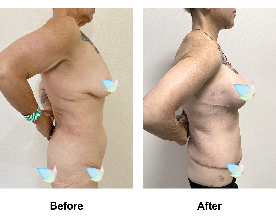 Deborah had Semi Circum TT + ML + Lipo2 + AL + SL + BABL +Lipo on arms with Dr. Eddy (1)