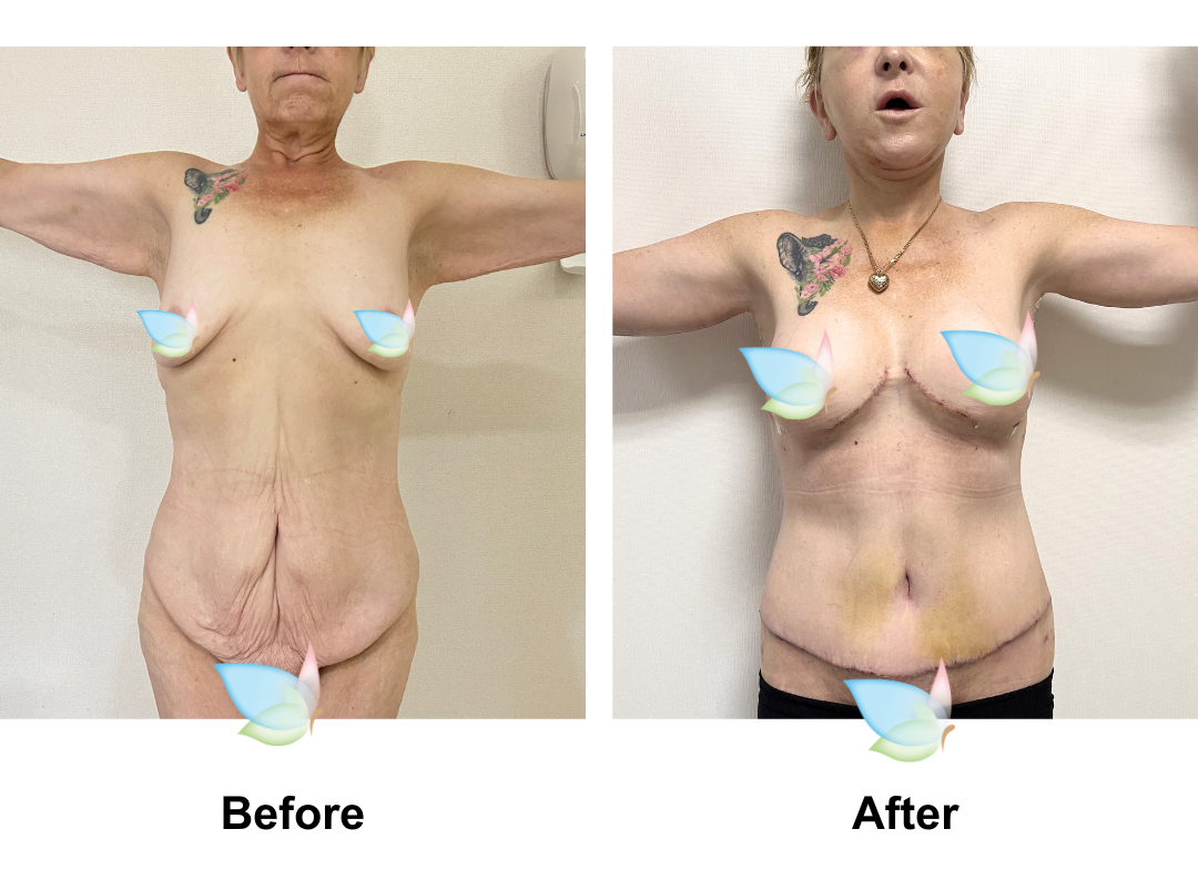 Deborah had Semi Circum TT + ML + Lipo2 + AL + SL + BABL +Lipo on arms with Dr. Eddy