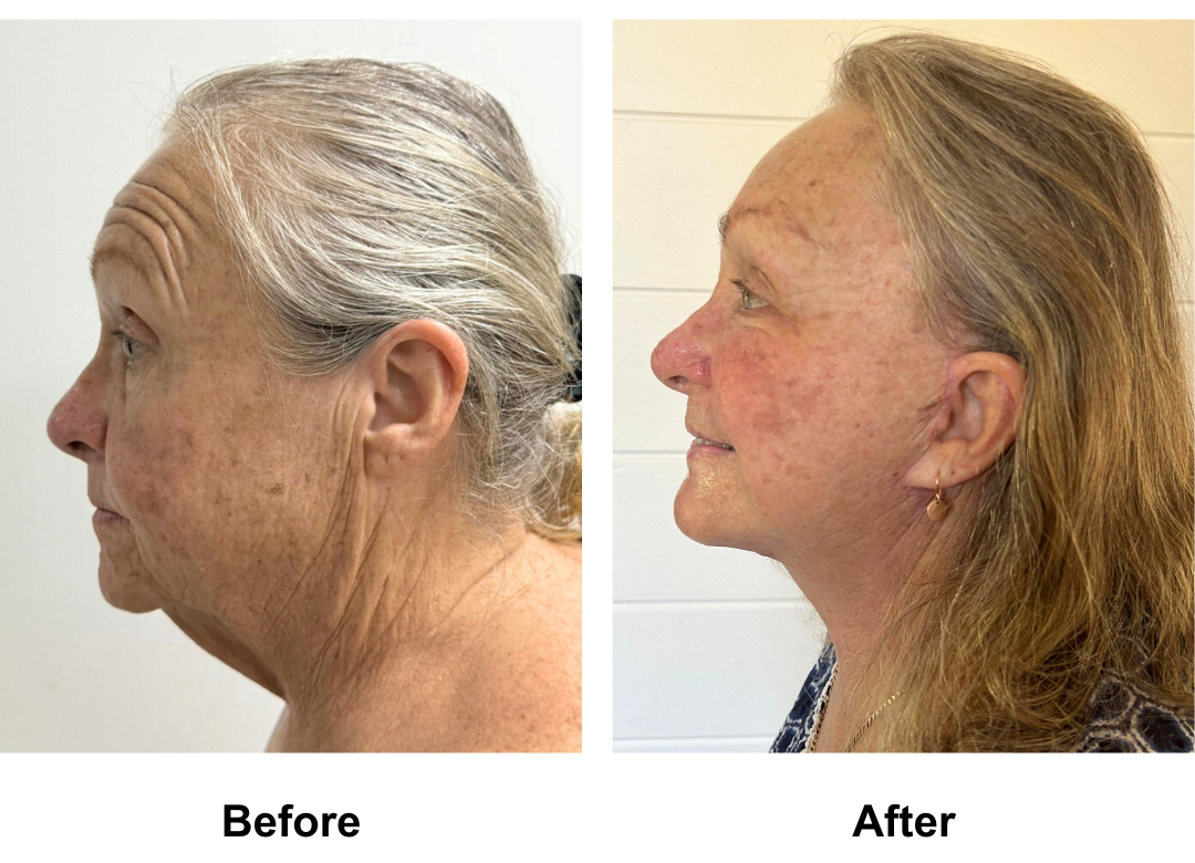 Deborahs FFNL + Fat transfer to Face + Chin Lift + Endo brow lift + LB  with Dr. Ring (2)