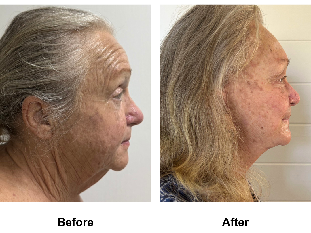 Deborahs FFNL + Fat transfer to Face + Chin Lift + Endo brow lift + LB  with Dr. Ring (3)