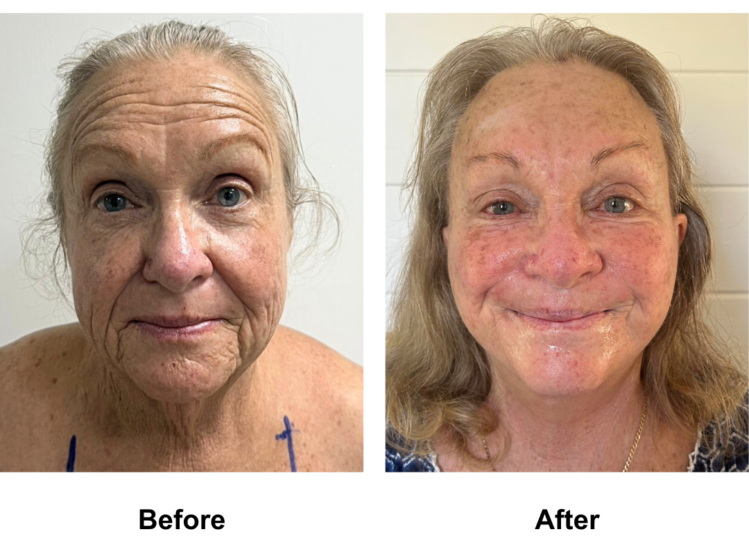 Deborahs FFNL + Fat transfer to Face + Chin Lift + Endo brow lift + LB  with Dr. Ring