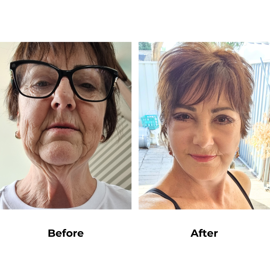 Debras FFNL + Rev. UB + Plastysmaplasty(R) - 1 month (1)
