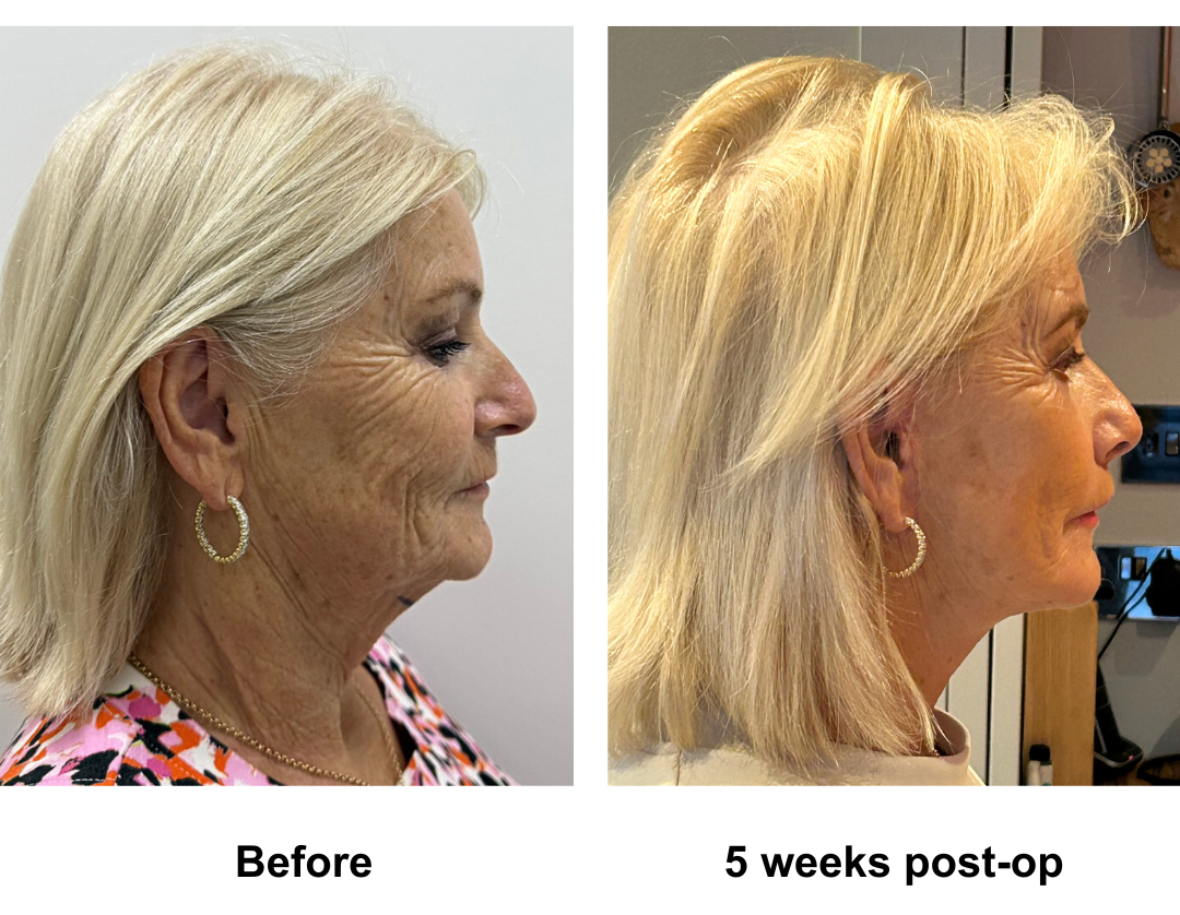 Denise had MFNL + Chin lift + Upper lip lift + Rev. LB with Dr. Ring  (2)