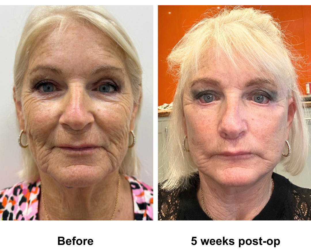 Denise had MFNL + Chin lift + Upper lip lift + Rev. LB with Dr. Ring  (5)
