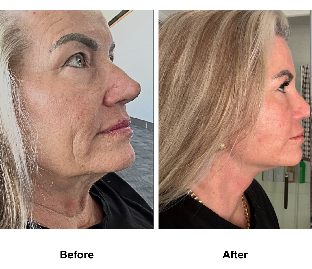 Denise, 60 had MFNL + UB + Fat transfer to face with Dr. NJ (1)