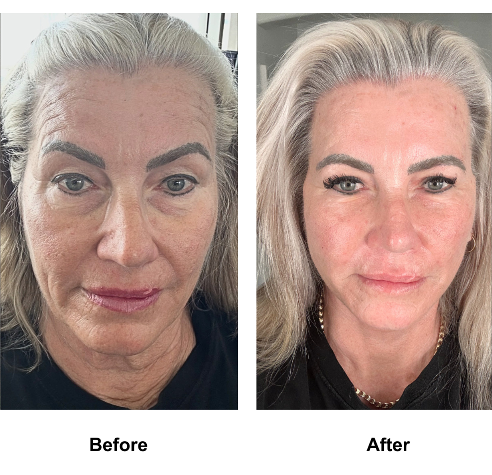 Denise, 60 had MFNL + UB + Fat transfer to face with Dr. NJ