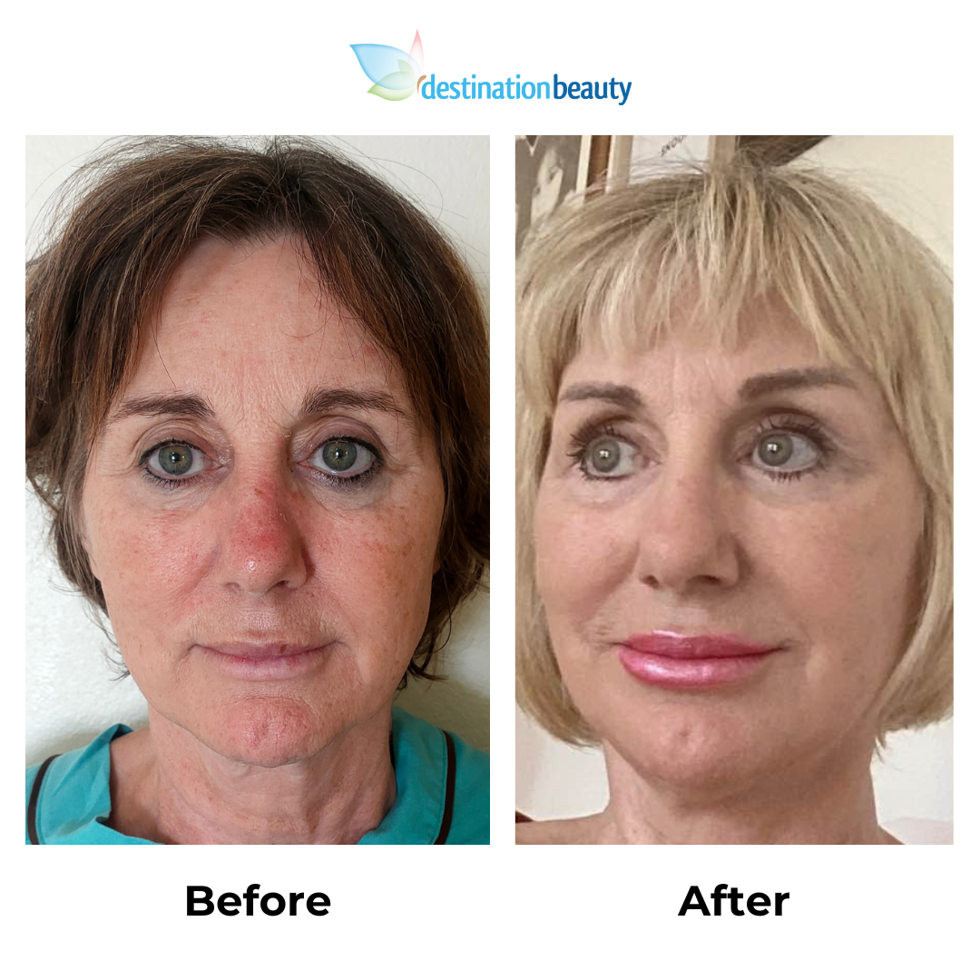 Donna before and after facelift (2)