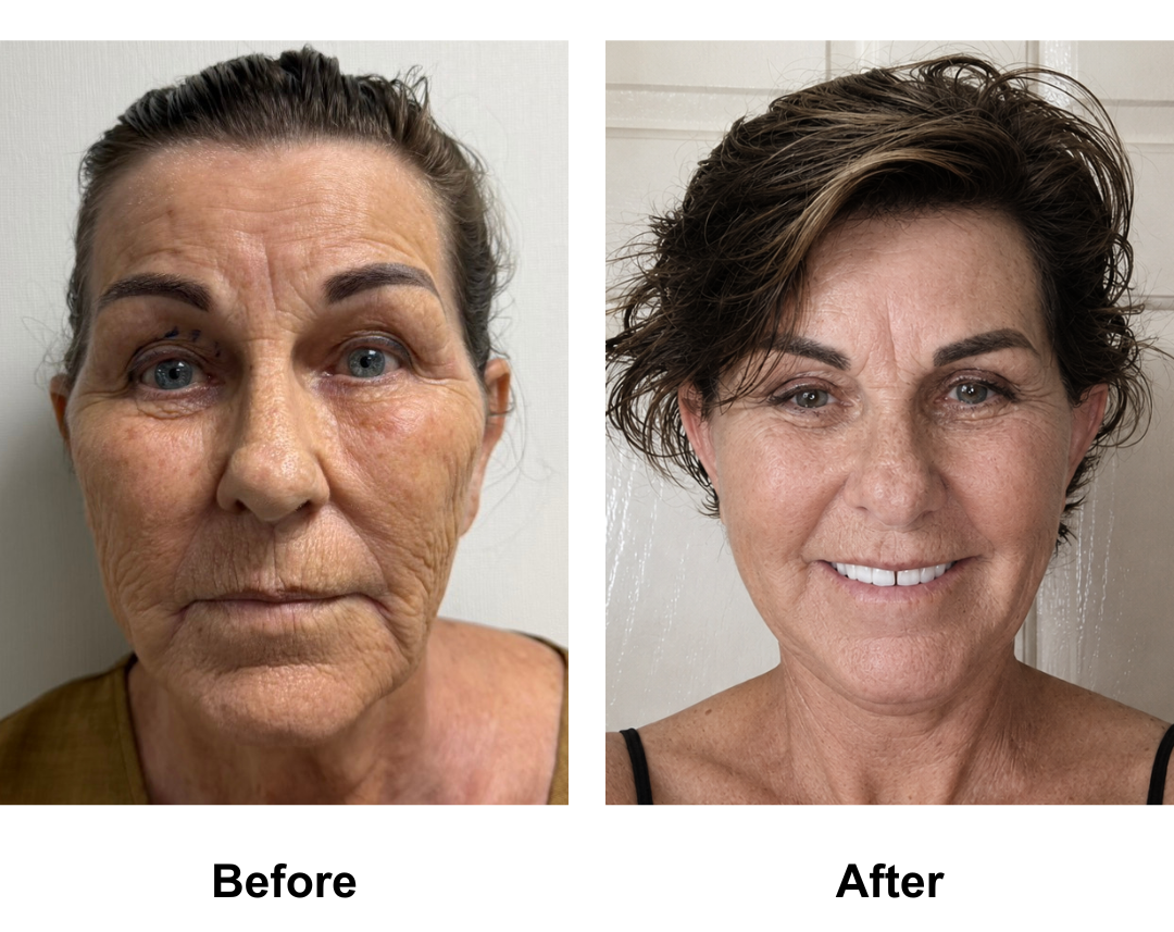 Donna had FFNL + UB with Dr. Ring (4)