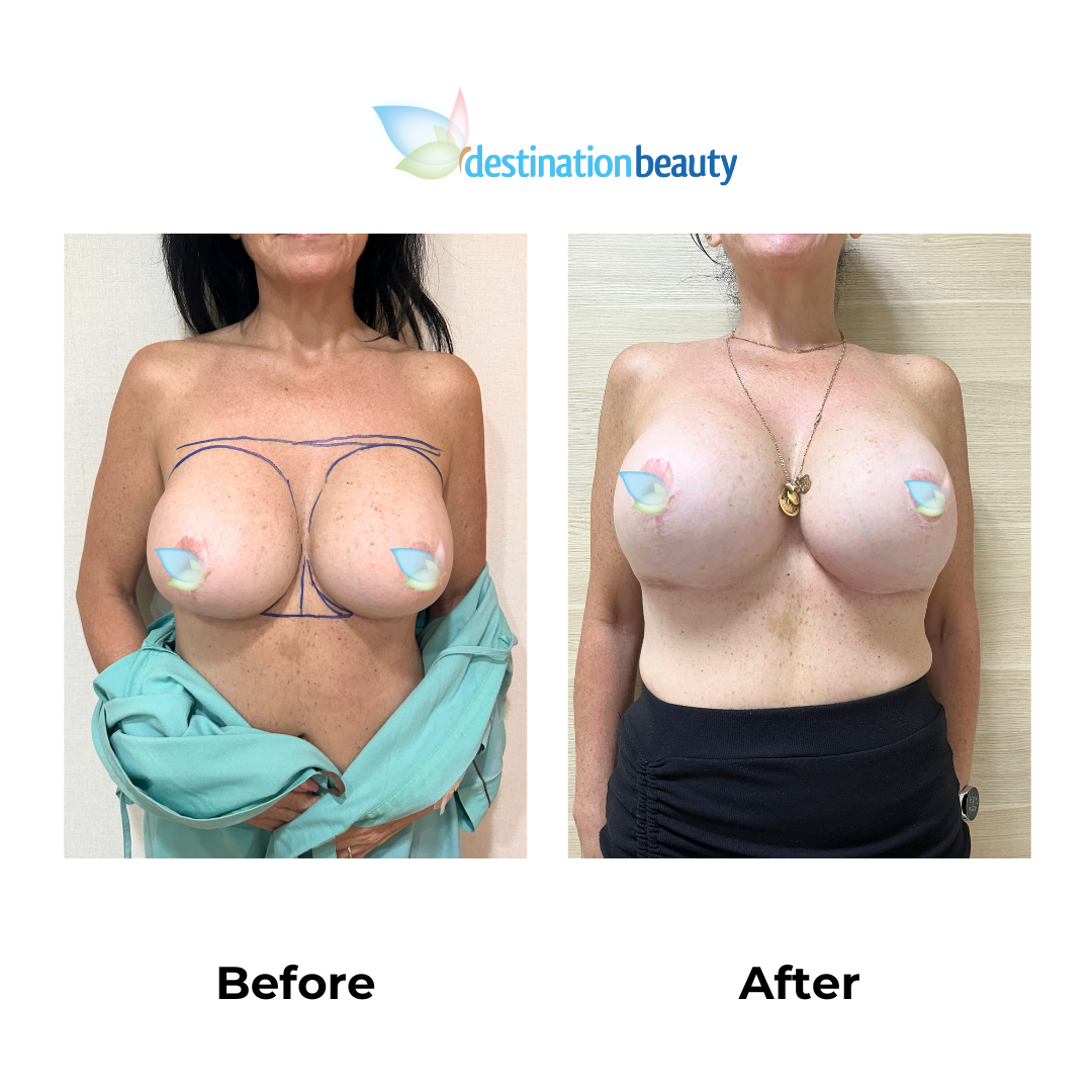 Donna had breast augmentation in Thailand