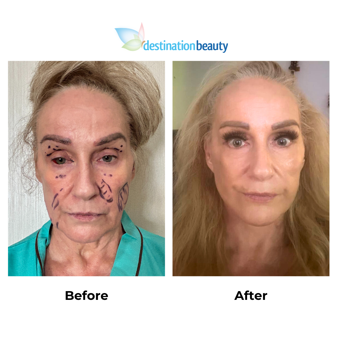 Donna had facelift with Dr. Ring (2)