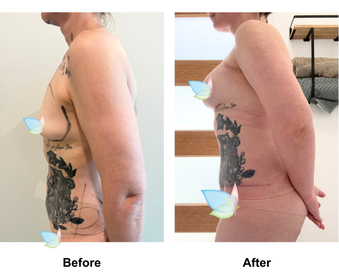 Eliza had  Ex TT + Lipo on upper abs + BA with Dr. Jatuporn (1)
