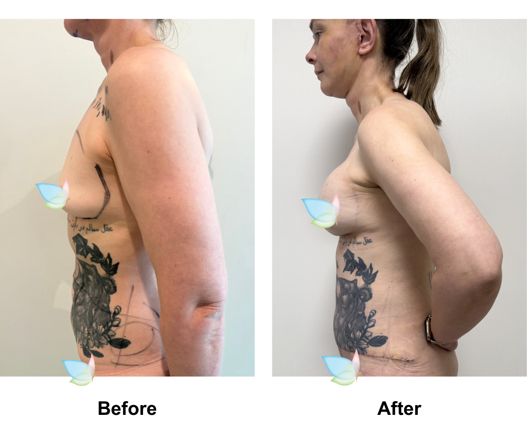 Eliza had  Ex TT + Lipo on upper abs + BA with Dr. Jatuporn (2)