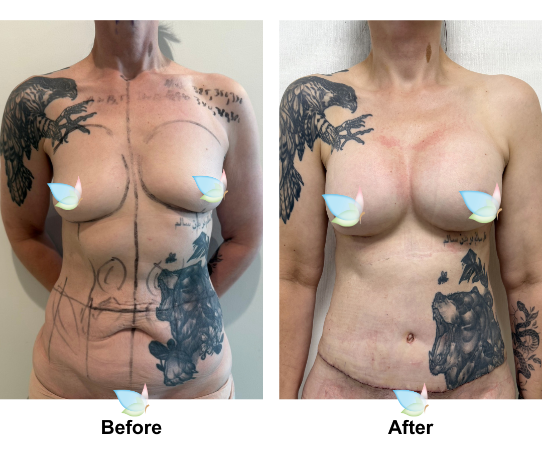 Eliza had  Ex TT + Lipo on upper abs + BA with Dr. Jatuporn