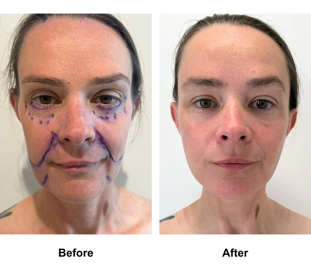 Eliza had MFNL + Fat trasnfer to face + Chin Lift with Dr. Jatuporn (1)