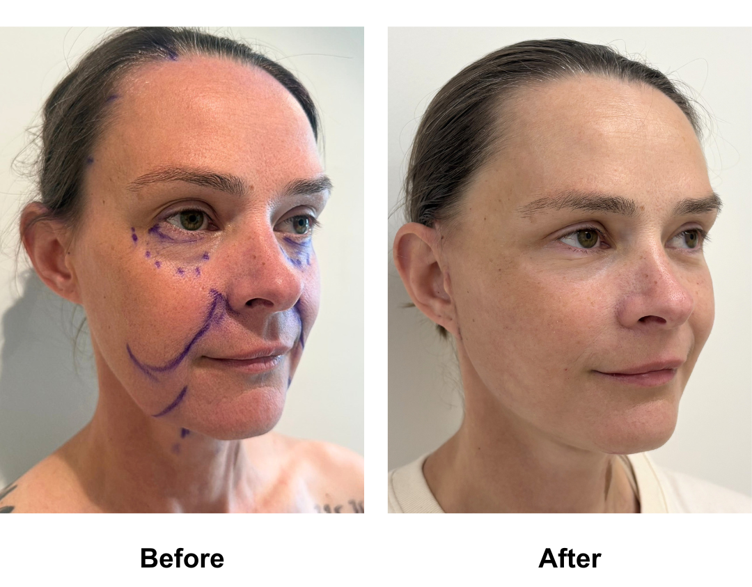 Eliza had MFNL + Fat trasnfer to face + Chin Lift with Dr. Jatuporn (2)