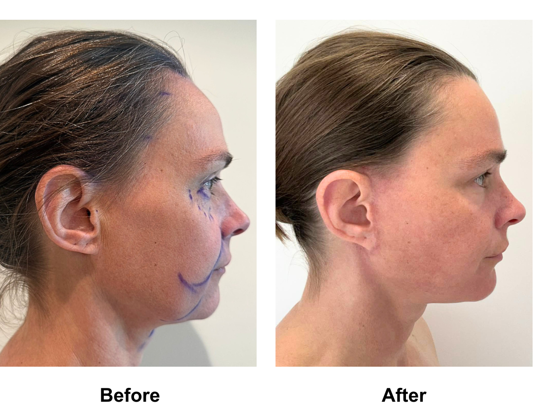 Eliza had MFNL + Fat trasnfer to face + Chin Lift with Dr. Jatuporn (4)