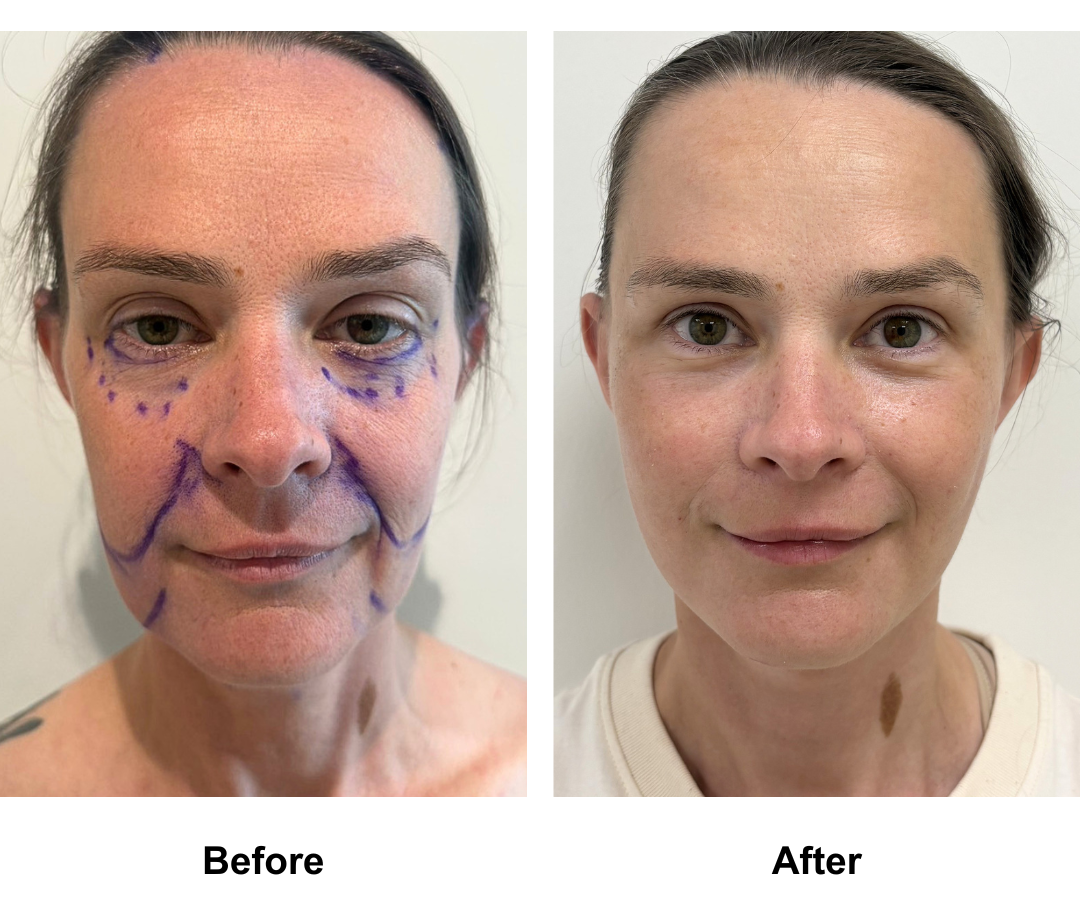 Eliza had MFNL + Fat trasnfer to face + Chin Lift with Dr. Jatuporn