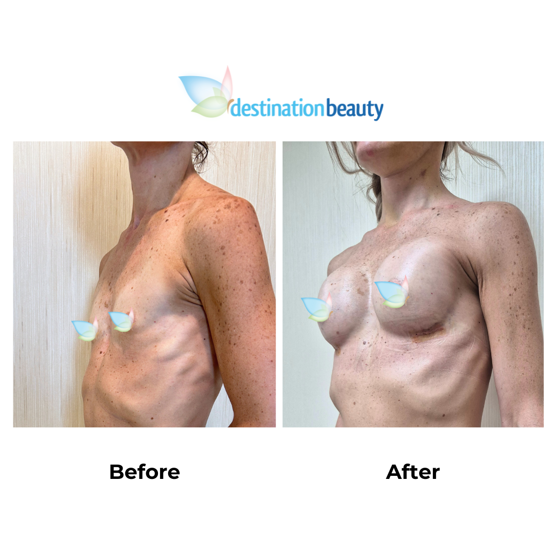 Elma had breast augmentation in Thailand with Dr. NJ