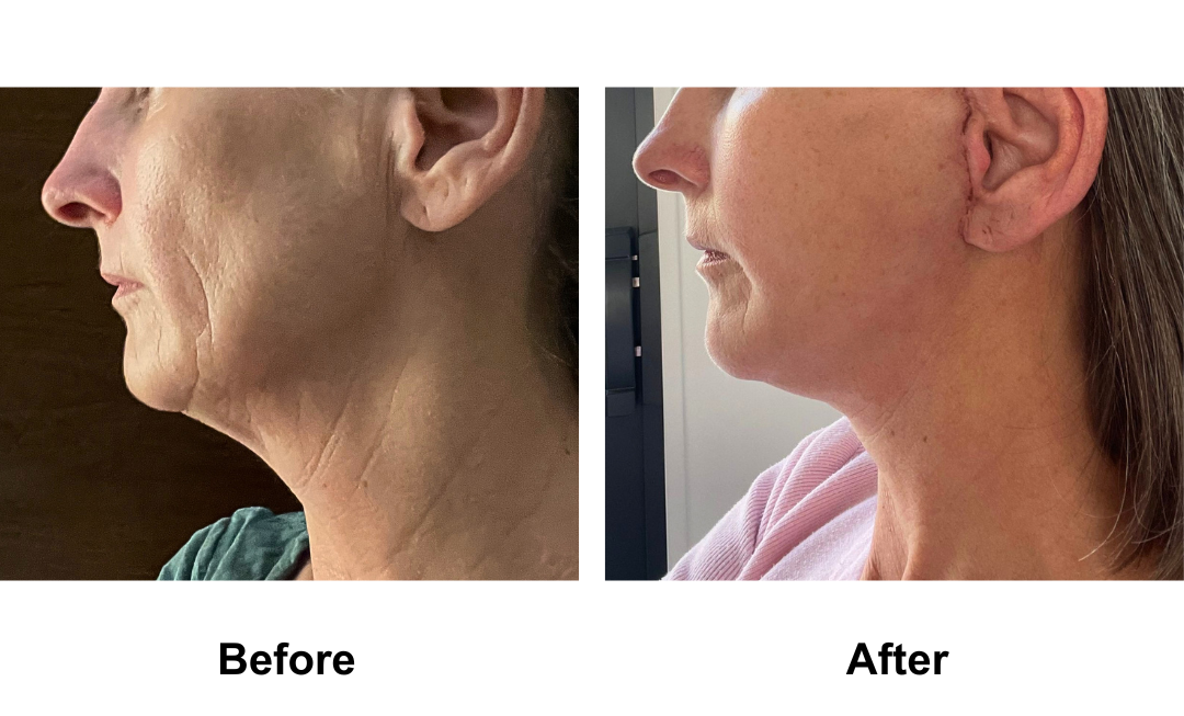 Eloise, 53 had MFNL + LB with Dr. Jatuporn (1)-1
