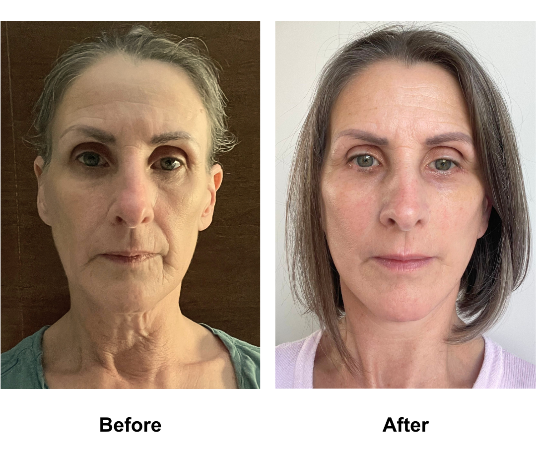 Eloise, 53 had MFNL + LB with Dr. Jatuporn (1)