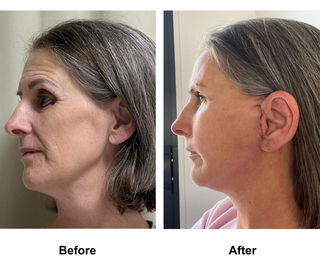 Eloise, 53 had MFNL + LB with Dr. Jatuporn (2)