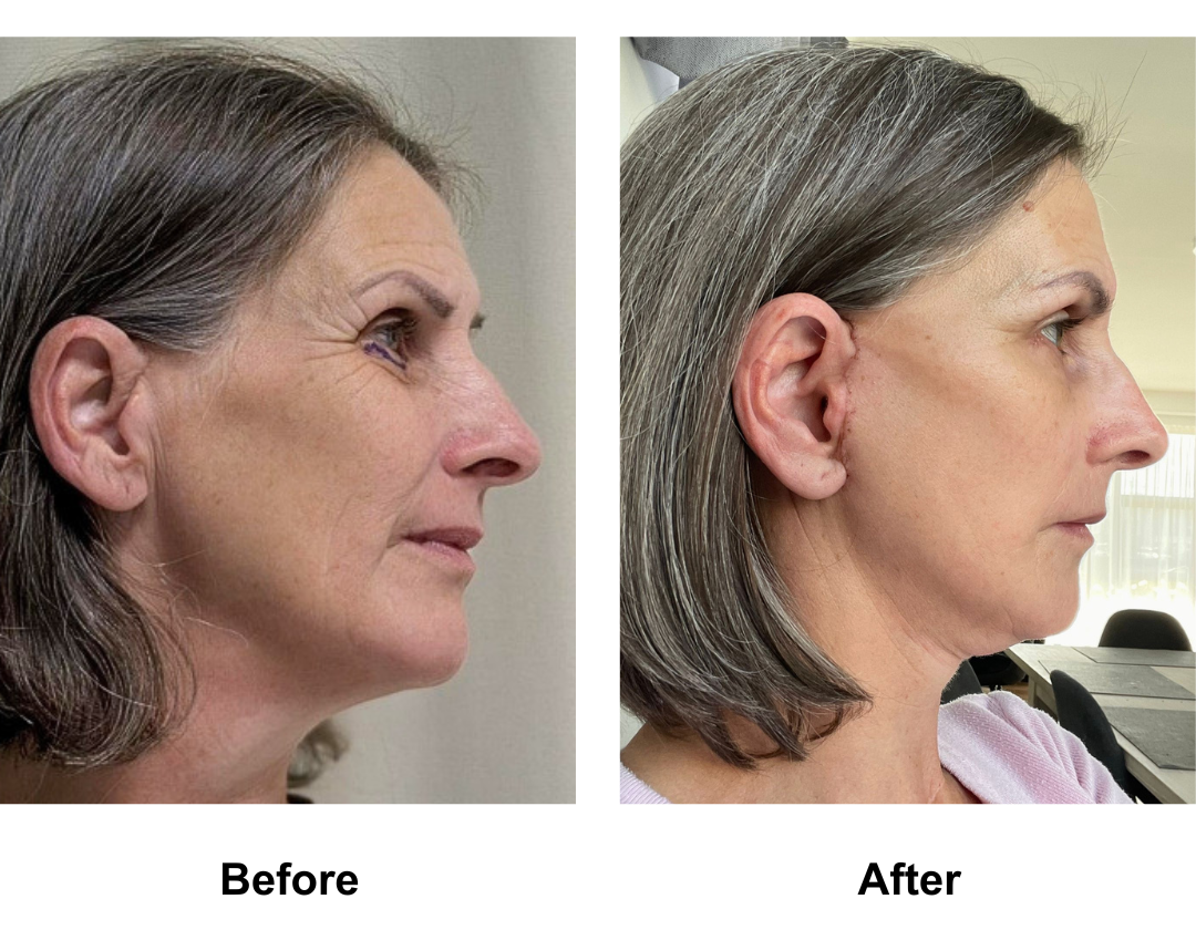 Eloise, 53 had MFNL + LB with Dr. Jatuporn (3)