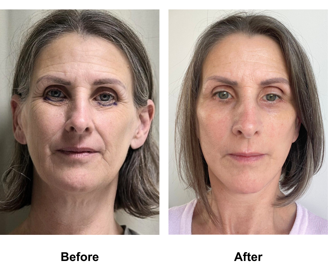 Eloise, 53 had MFNL + LB with Dr. Jatuporn