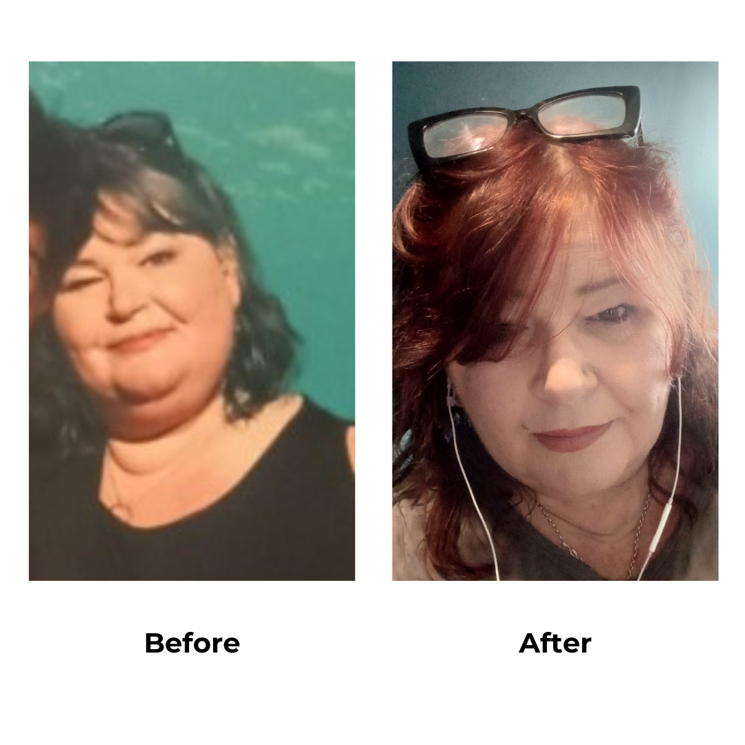 Emerie had gastric sleeve with Dr. Narong