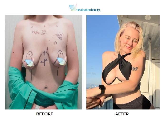 Emily Cook breast augmentation