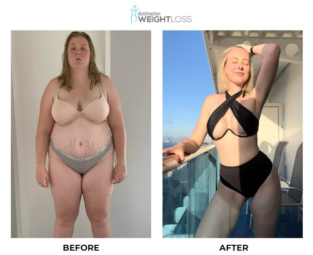 Emily Cook weight loss surgery 