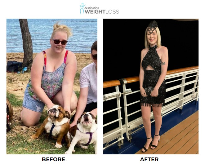 Emily Cook weight loss surgery 2