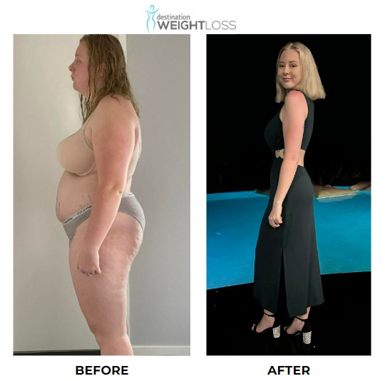 Emily Cook weight loss surgery 3