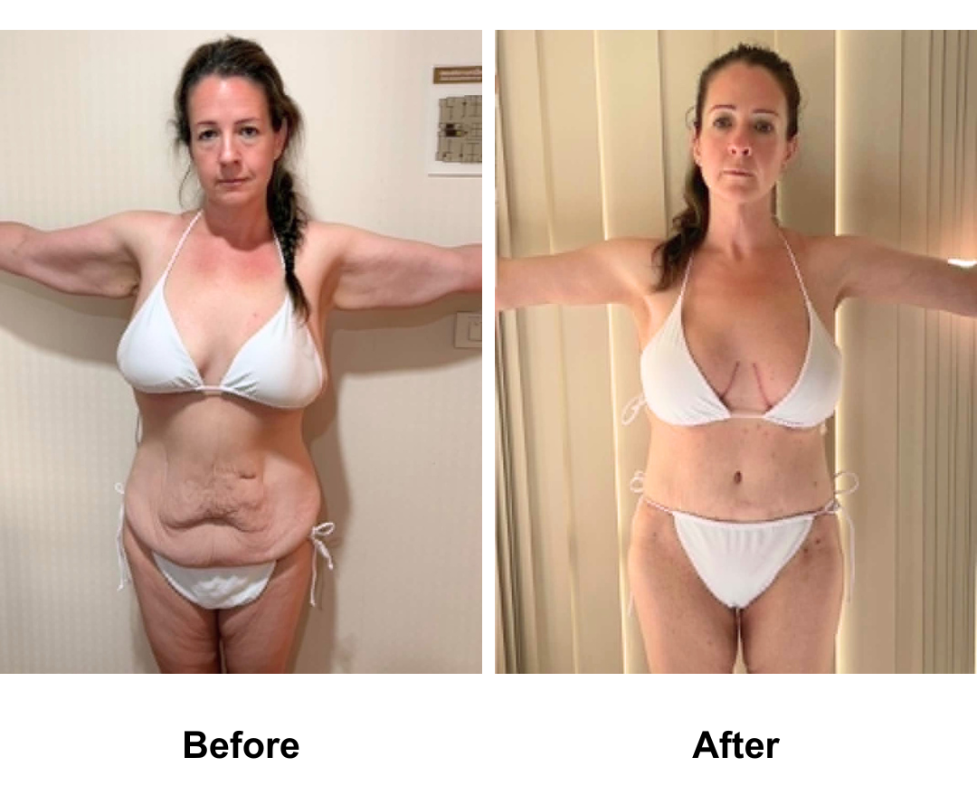 Emma had AL + BABL(250, 275 HP) + SL + ExTT + Lipo2 + Mons Lift with Dr. Ring  (1)